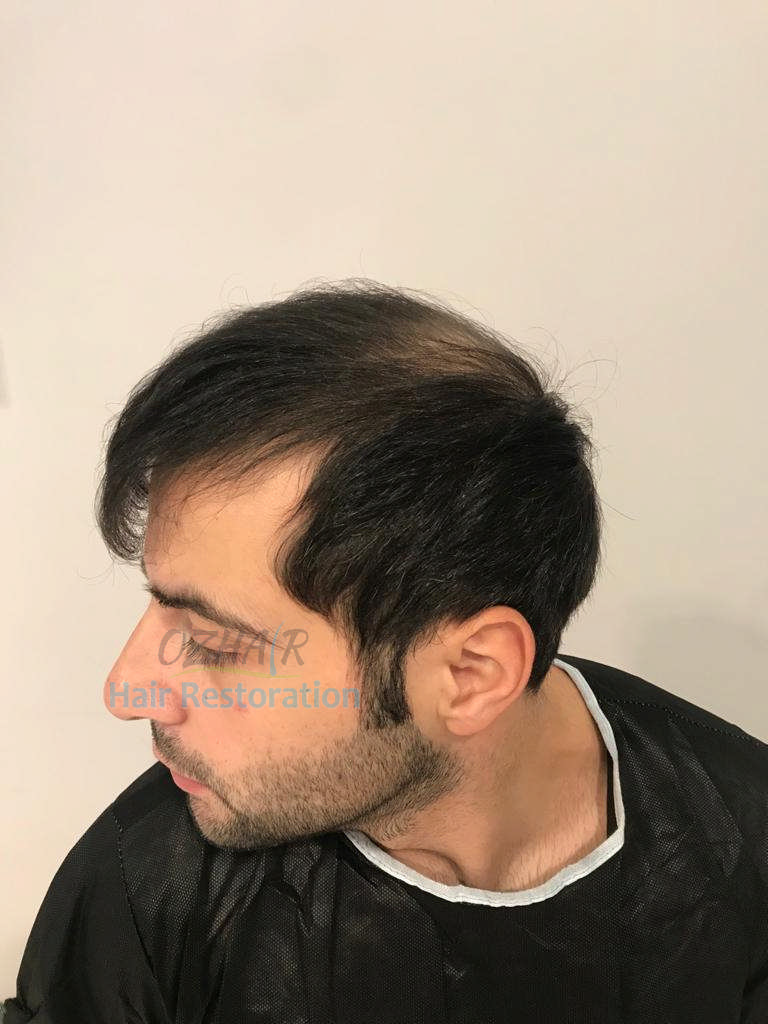 BEFORE