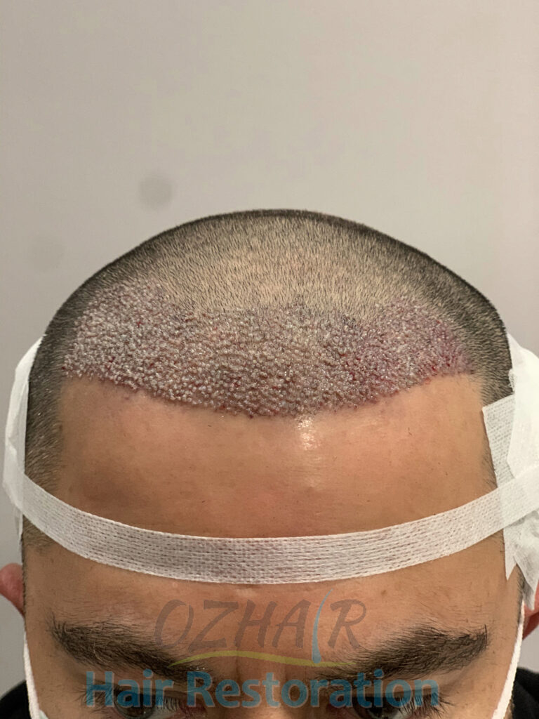 POST OP