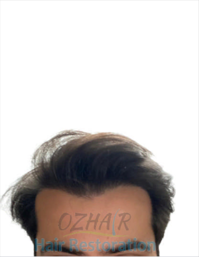AFTER 12 MONTHS