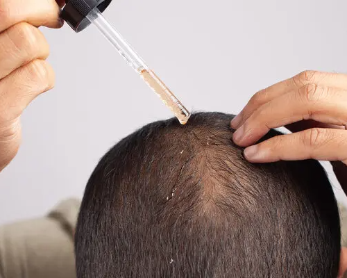 18sci-hairloss2-articleLarge