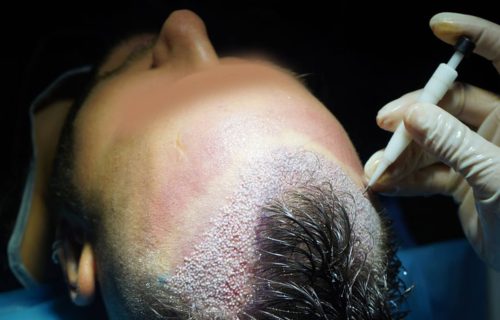DHI-HAIR-TRANSPLANT-ISTANBUL-COST