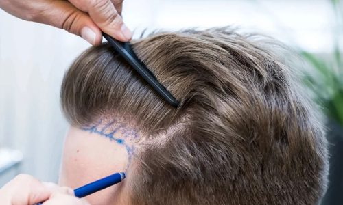 Follicular-Unit-Extraction-FUE-H Follicular-Unit-Extraction-FUE-H