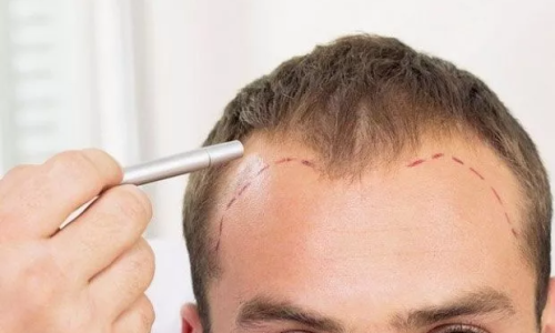 before-dhi-hair-transplant before-dhi-hair-transplant